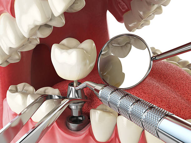 Best Emergency Dentist for Lost Fillings or Crowns in Schnecksville, PA